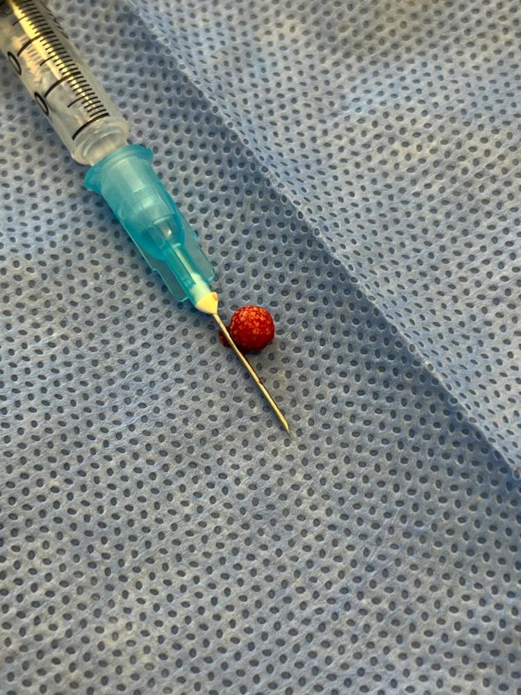 The size of his urinary stone